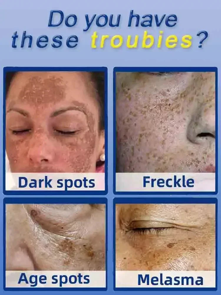 Dark Spot Remover for Face