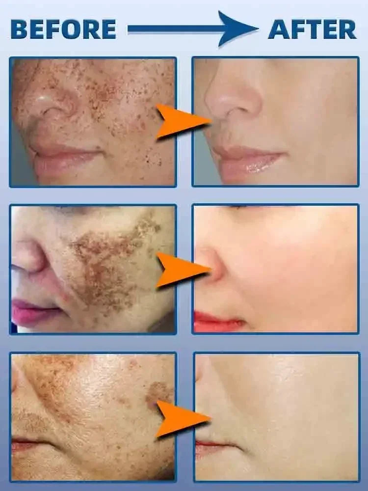 Dark Spot Remover for Face